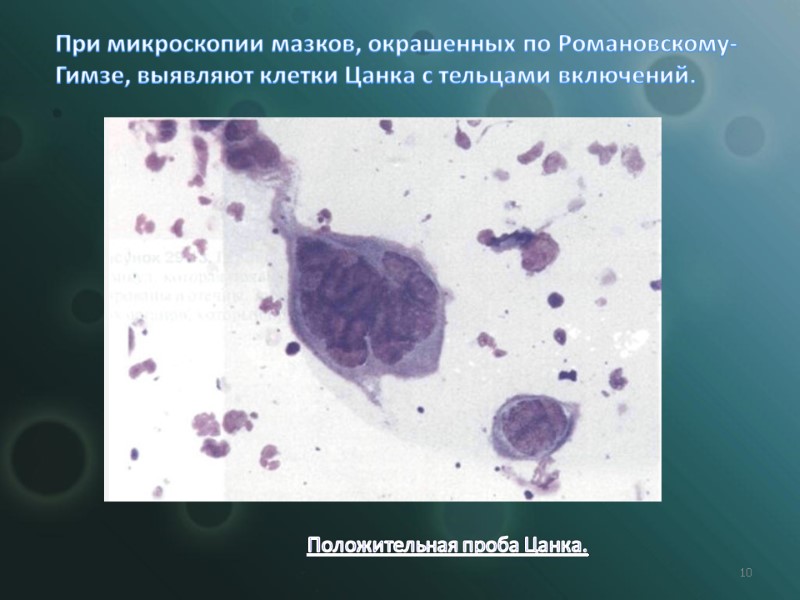 10 При микроскопии мазков, окрашенных по Романовскому-Гимзе, выявляют клетки Цанка с тельцами включений. 